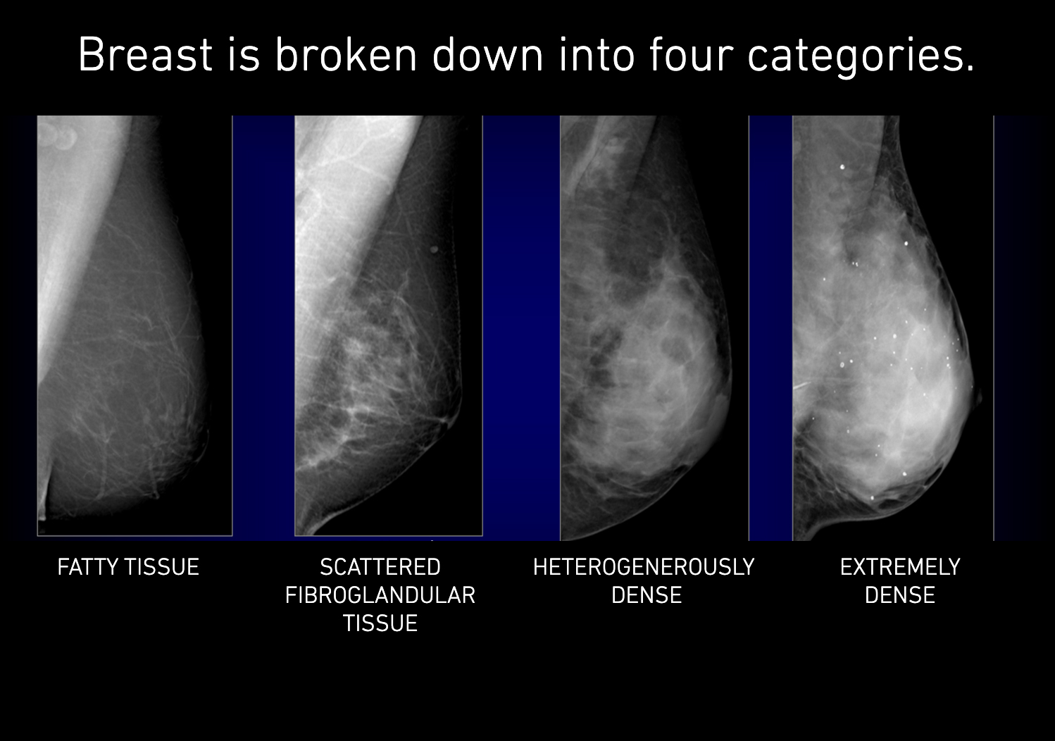 four categories of breast density