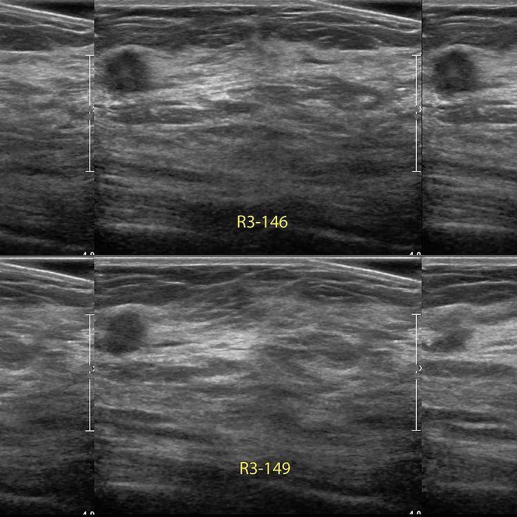 automated breast ultrasound square