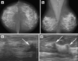 how does automated whole breast ultrasound compare to mammography in dense breast 5d370e30a9fef